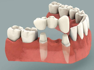 Dental-Bridges-400-x-300-PX