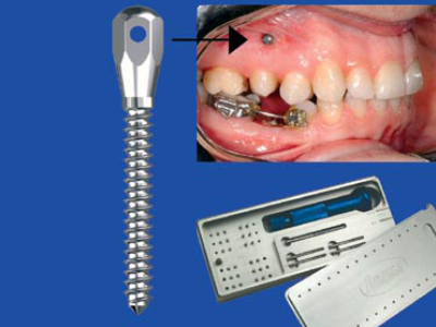 Ortho-Implant-400-x-300-PX