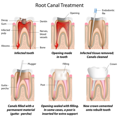 Root-Canal-Treatment-400-x-400-PX