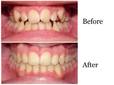 brett-before-and-after-intraoral-400-x-300-PX